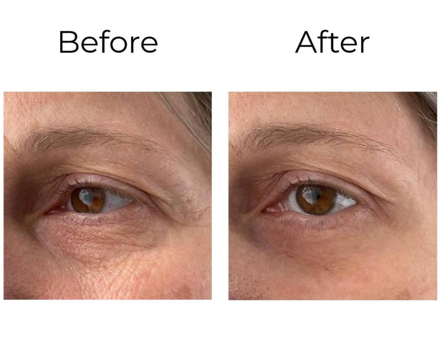 PEPTILUX Anti-Falten Augencreme "Shock Action"